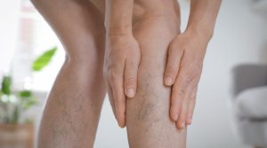 Cuidar tus varices en otoño: consejos para mejorar la circulación y prevenir molestias