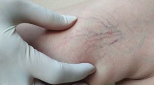 Por qué las varices duelen más al final del día (y qué puedes hacer para aliviarlo)