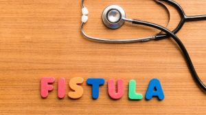Fístula anal: qué es, en qué se diferencia de un absceso y cómo cuidarla