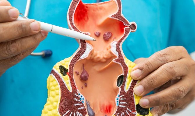 ¿Las hemorroides pueden desaparecer solas? Cuándo esperar y cuándo consultar a un especialista