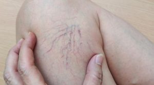 Arañas vasculares: por qué no deberías esperar a que vayan a más