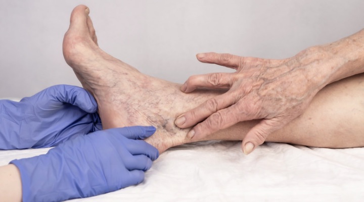 varices en madrid varices en madrid
